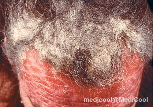 表现在额头上的红皮型银屑病已蔓延到头皮