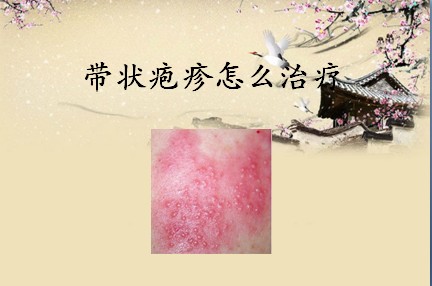 疱疹症状-如何快速治疗疱疹,疱疹症状图,带状疱疹,得了泡疹怎么办