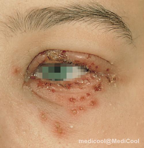 疱疹性湿疹(单纯疱疹