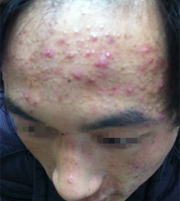 丘疹性痤疮