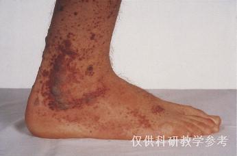 style="font-size:14px;line-height:2;">过敏性紫癜:紫癜样皮疹相互