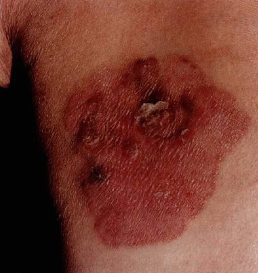 早期为淡红或暗红色丘疹和小斑片,一般无自觉症状,表面有少许鳞屑或