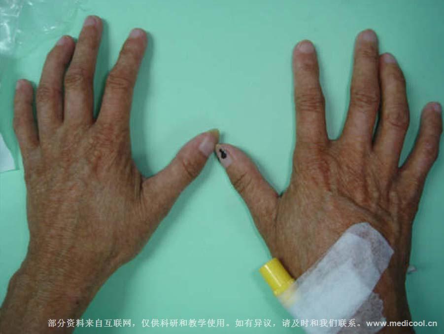 5;">werner综合征: /span> span style="font-family:"times new