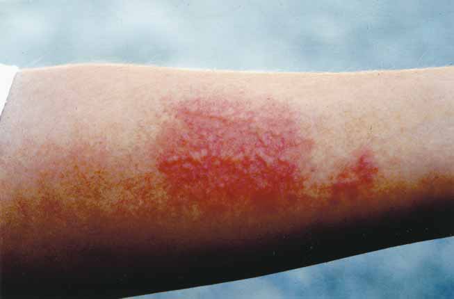 接触 rhizostoma pulmo图3  刺孢刺伤:左脸颊处的条纹状糜烂性皮损