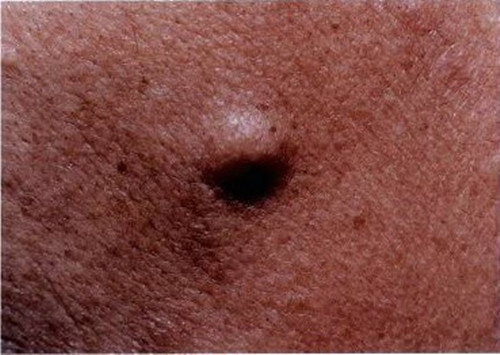 表皮囊肿是最常见的皮肤囊肿之一