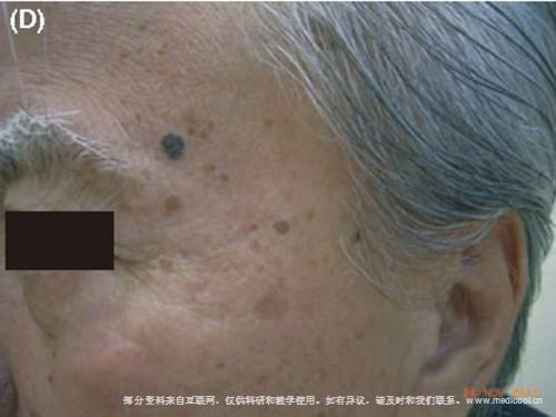 脂溢性角化病-面颈部