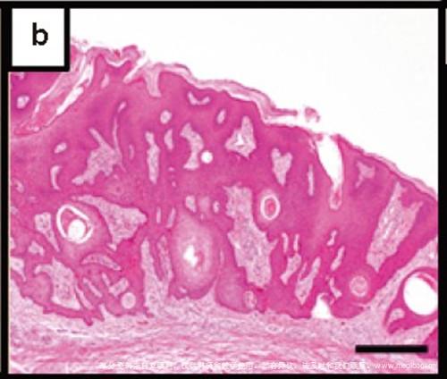 脂溢性角化病-组织病理