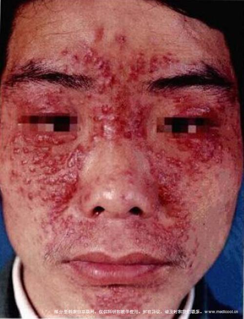 5;">颜面部多数小结节,淡红色或淡紫褐色,散在或集簇,眼睑,颊